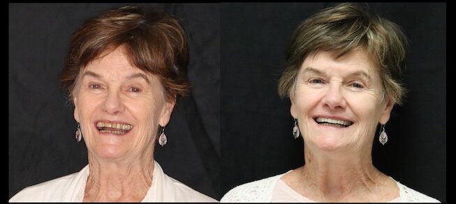 Before and after crowns